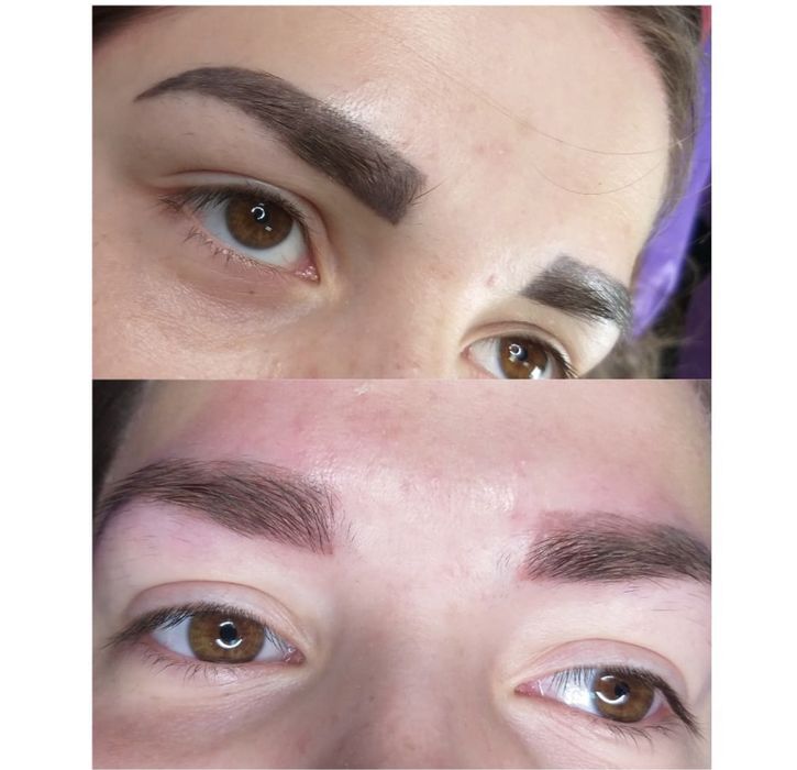 Видалення тату і перманентного макіяжу будь якої складності від 500грн