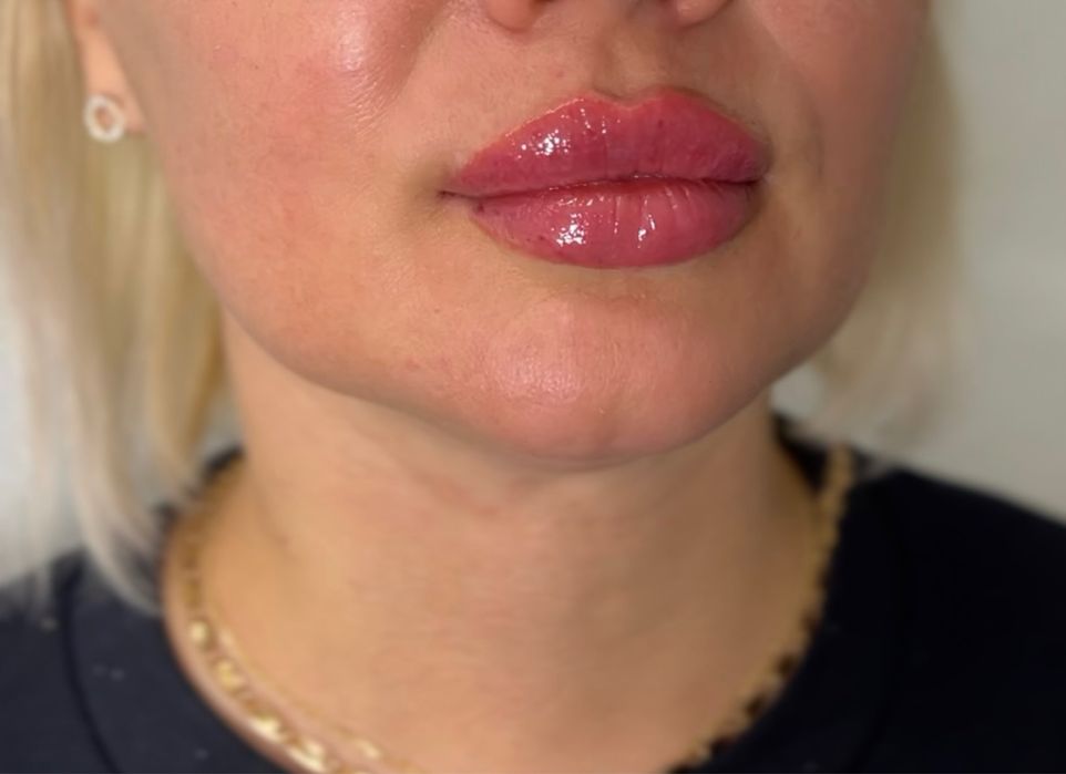 Збільшення губ. Увеличение губ,контурная пластика лица.