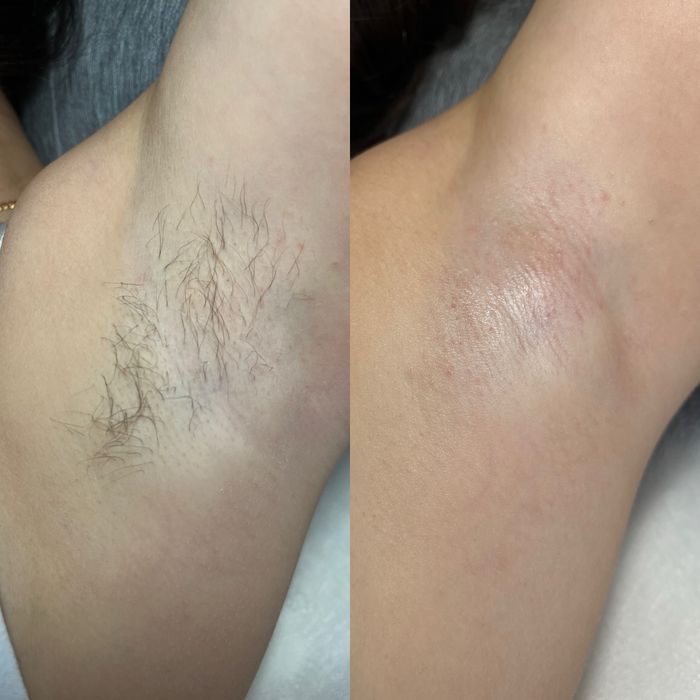 Депіляція Віск Шугарінг