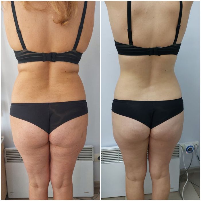 Массаж , лазерная эпиляция, пресотерапия Горняцкий ,Червоная