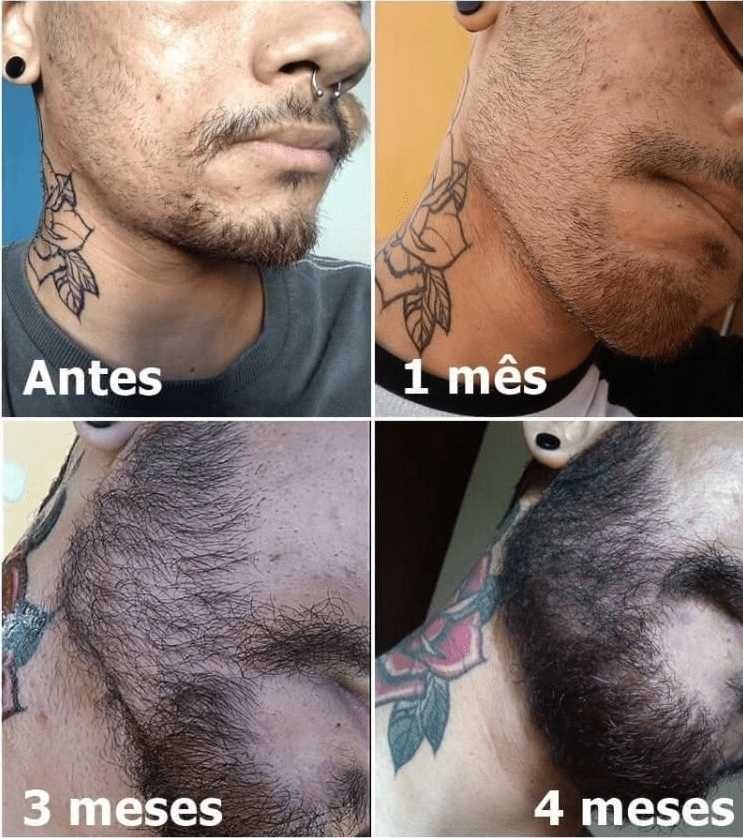 Kirkland Minoxidil Crescimento de Cabelo e Barba