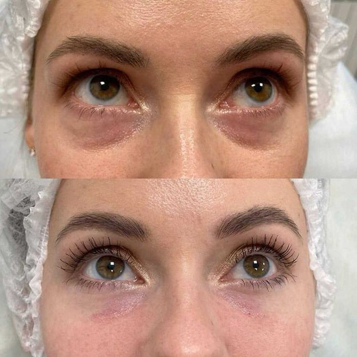 Косметолог, БЕЗБОЛІСНА процедура - зона під очі по Акції - 500 грн.!