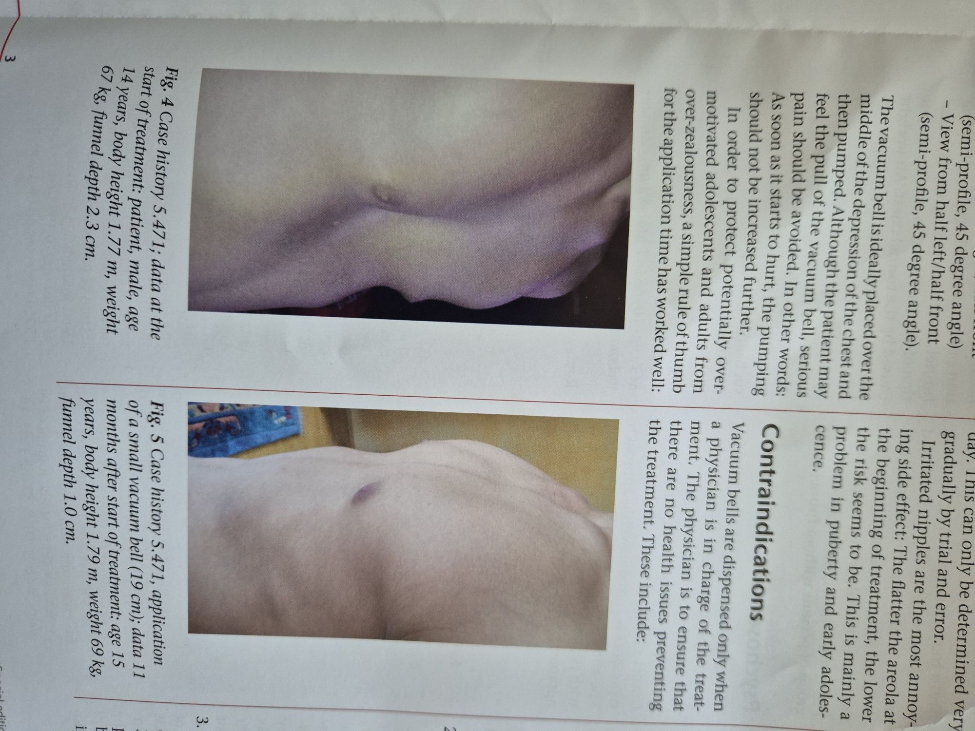 Ventosa de silicone