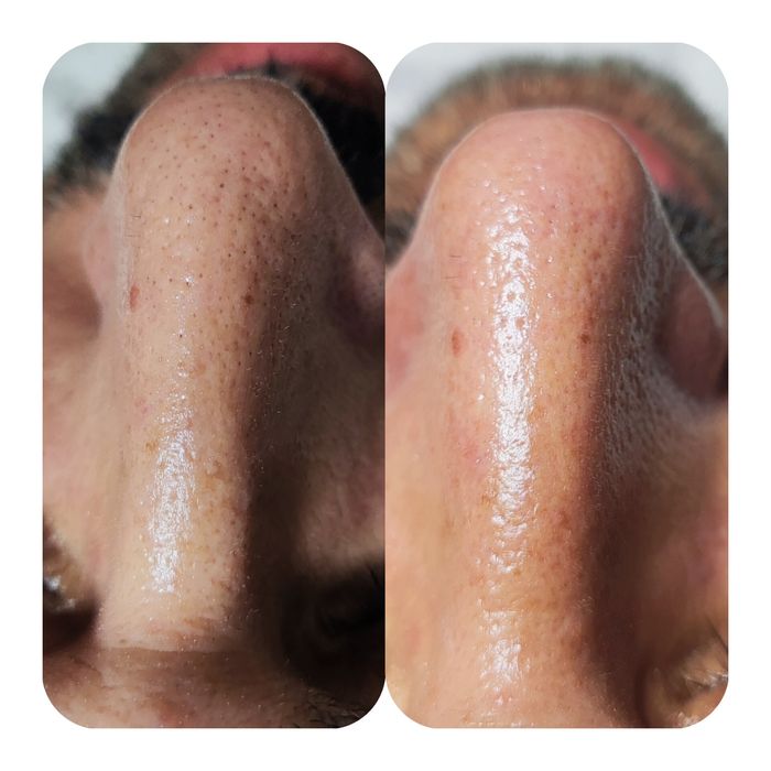 Limpeza de pele profunda