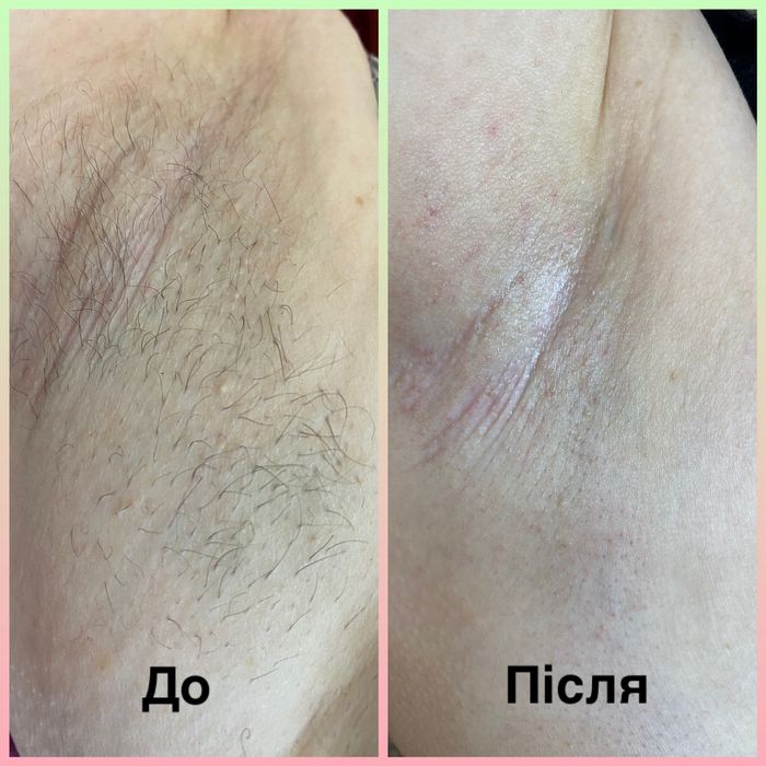 Шугаринг,воскова депіляція.