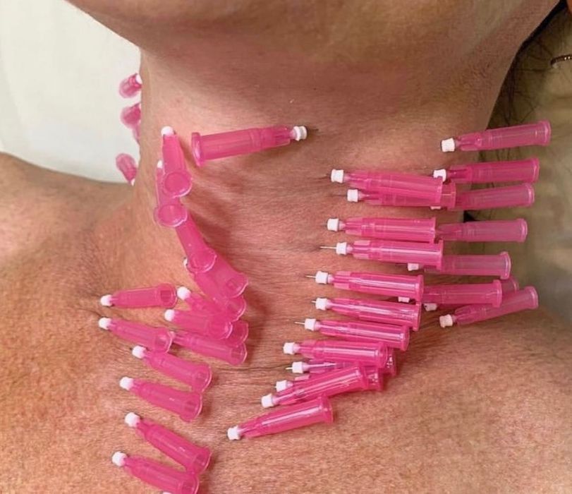 Ботокс, мезонити, увеличение губ,ягодиц