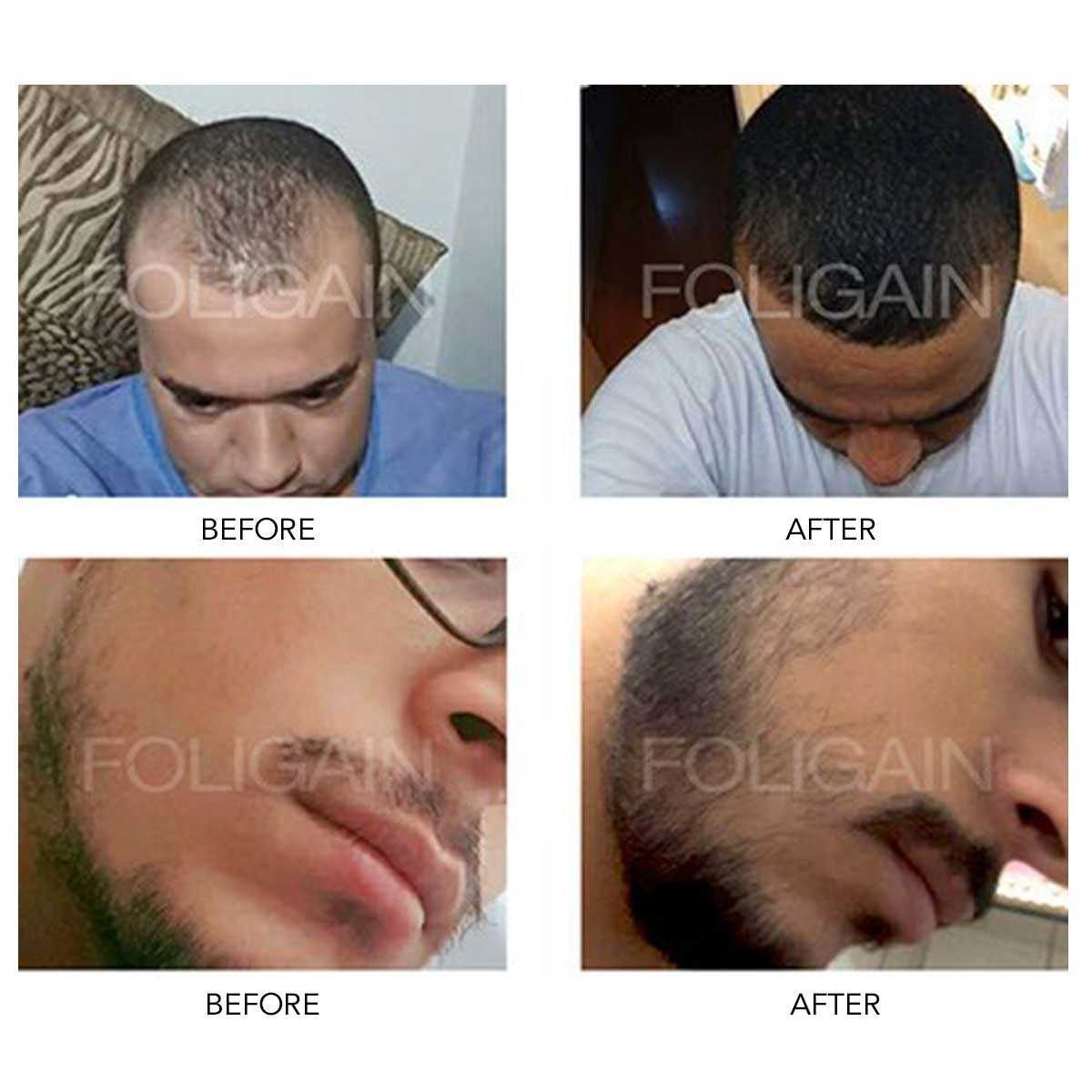 kit 3 Minoxidil tb versão baixo Álcool Entrega Grátis em Cascais