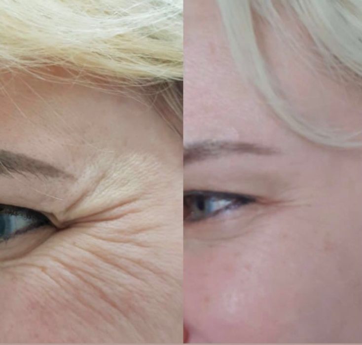 Ботокс. Коррекция морщин,всё зоны, Фулфейс.