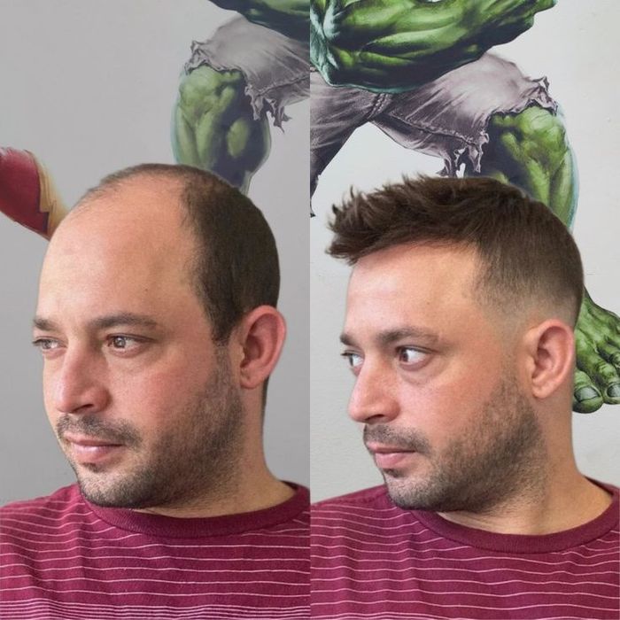 Curso Profissional de prótese capilar injetada em Alverca