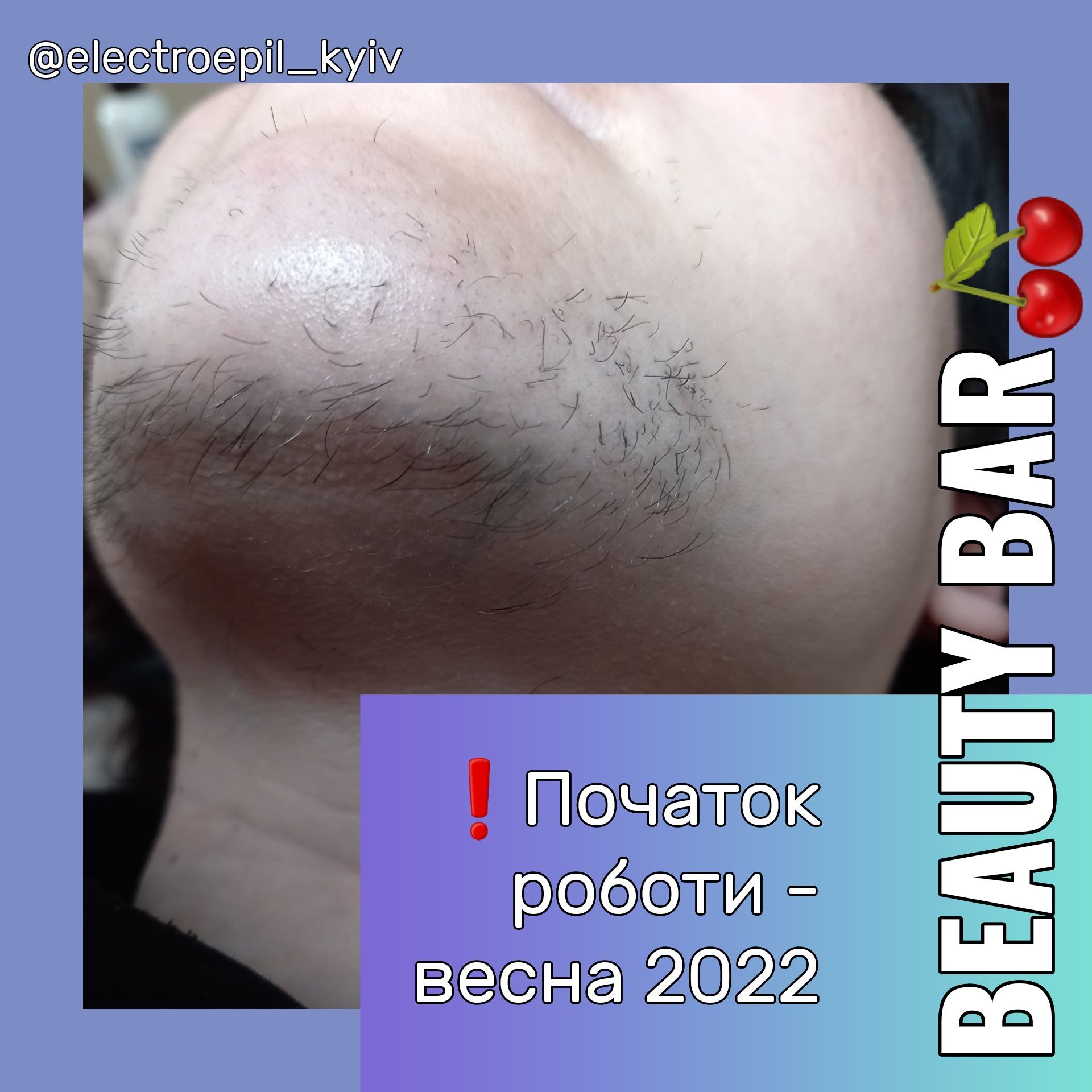 Електроепіляція Київ BeautyBar