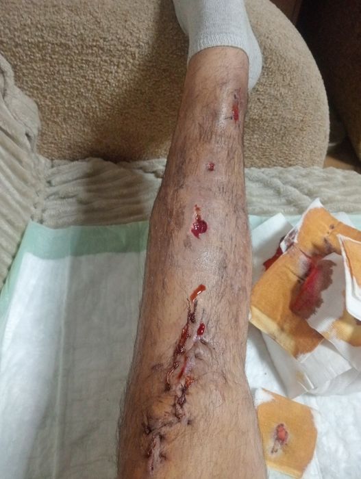 Люди допоможіть будь ласка на уколи обезболюєче