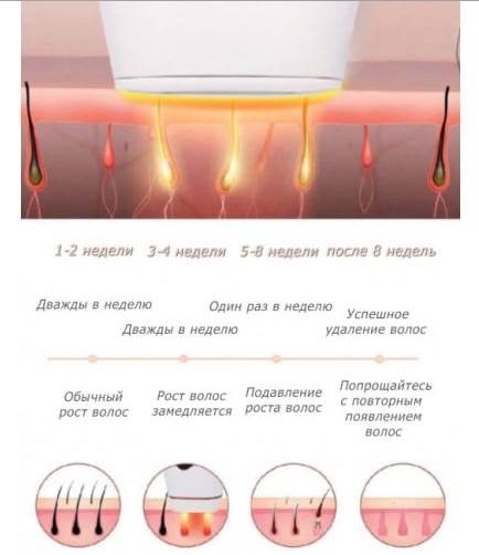 Лазерный эпилятор с IPL am001 intense pulsed light, для брюнеток !