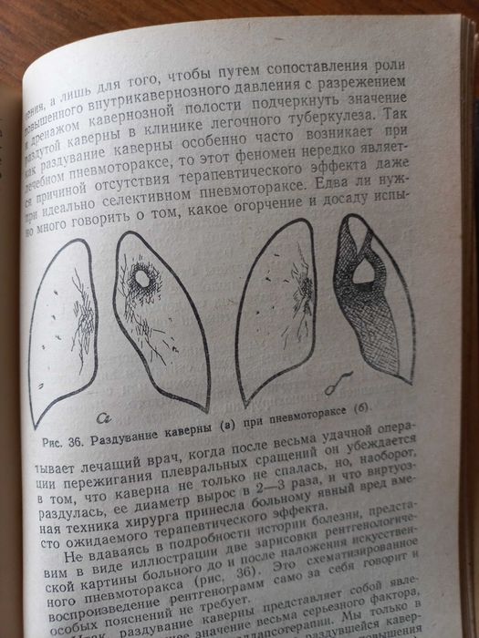 Равич-Щербо, В.А.,  Туберкулез легких у взрослых