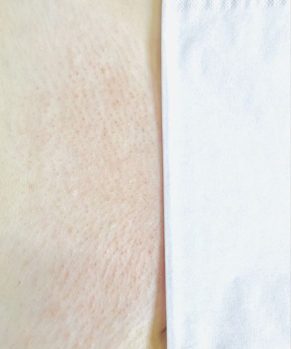 Депіляція—> Шугаринг—> Віск—> Електроепіляція Ірпінь