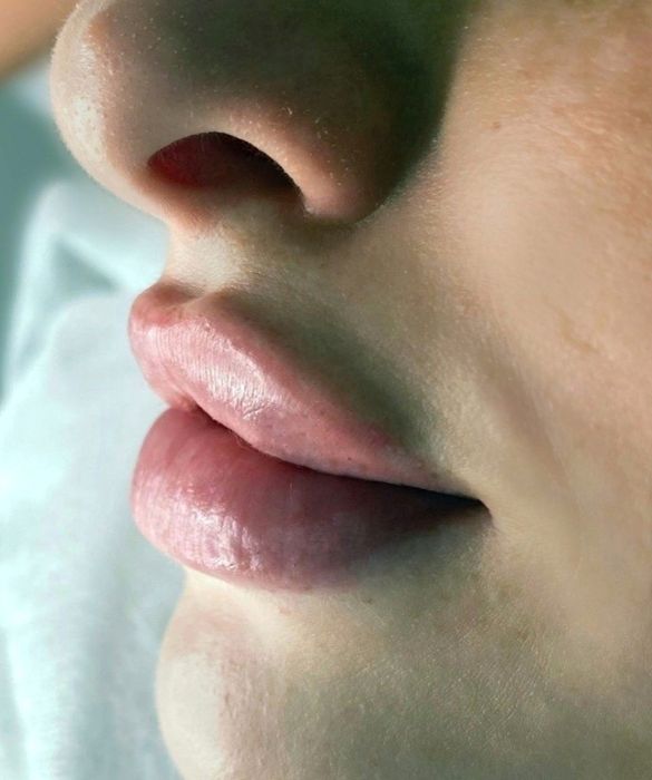 Пластика губ .Увеличение губ.Ботокс.