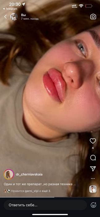 Модель на губы  ботокс Угли Джоли скули