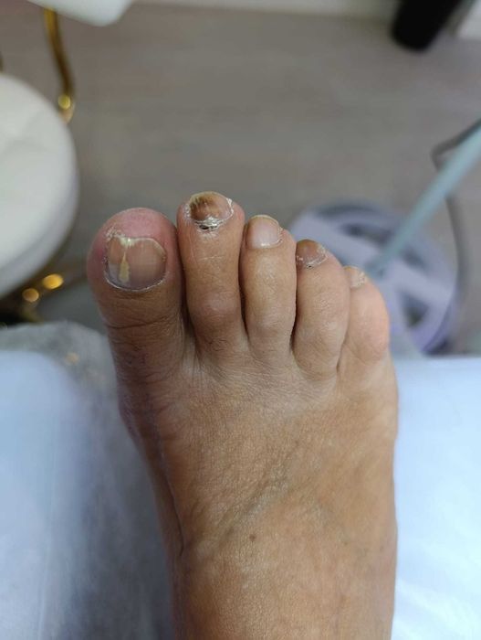 Tratamento fungos com laser