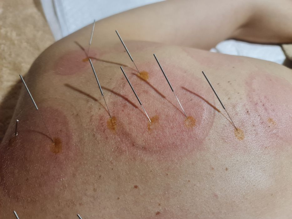 Гірудотерапія,хіджама, голковколювання,тибетський масаж