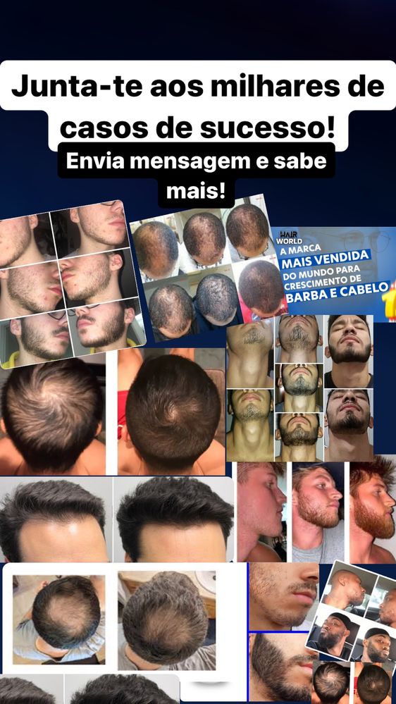 Minoxidil Espuma e liquido e derma roller