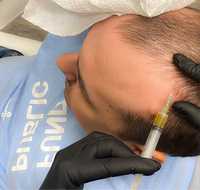 Мезотерапия кожи головы (волос) и бровей