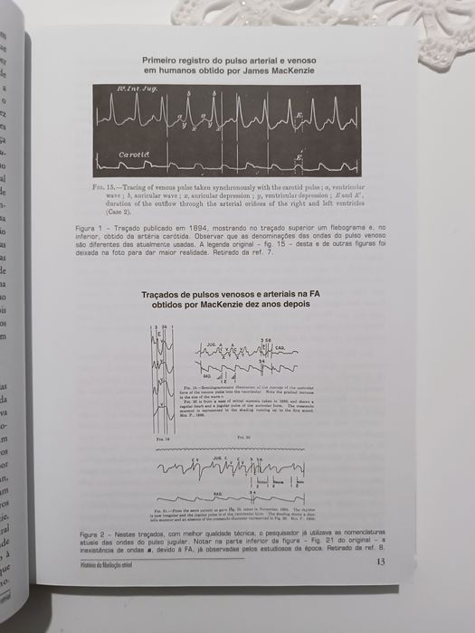 Livro "Fibrilação Atrial"