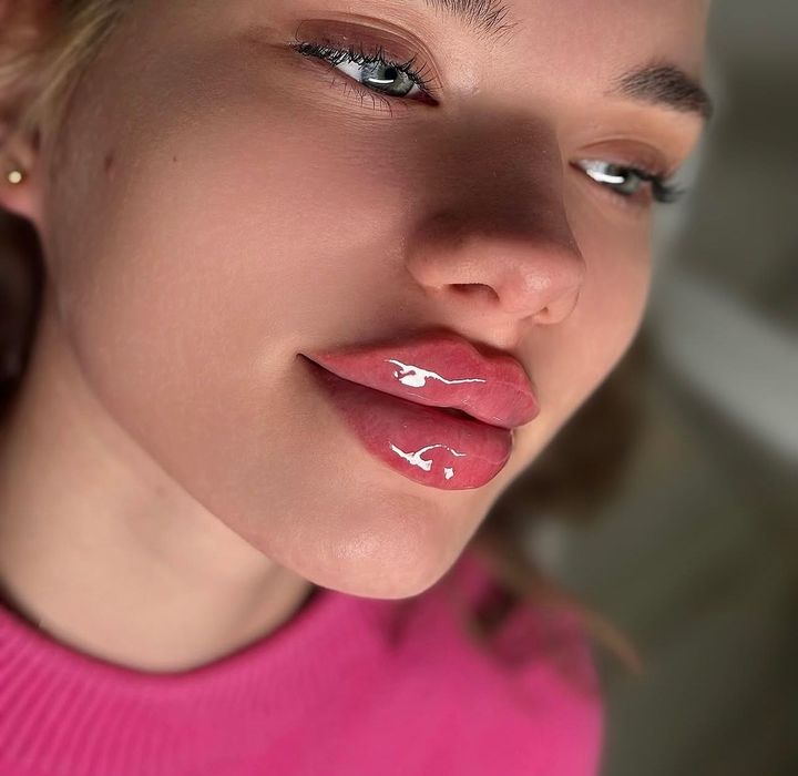 Збільшення губ та контурна пластика