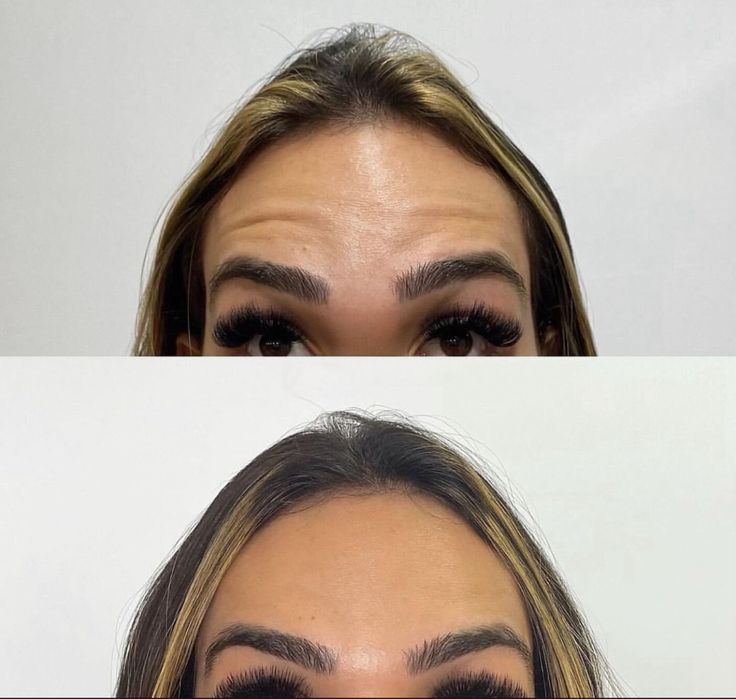 Botoks, Nici PDO/PLLA, Tropokolagen, Osocze Bogatopłytkowe