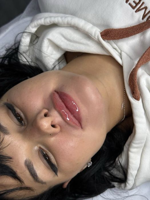 Збільшення губ,ботокс,мезотерапія,біоревіталізація,чистка обличчя