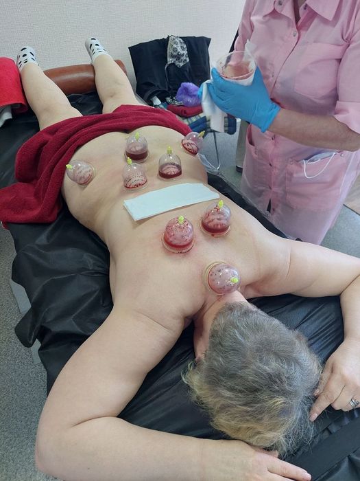 Гирудотерапия, пиявки,  хиджама