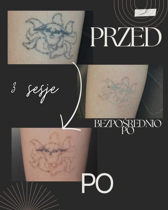 Laserowe Usuwanie Tatuażu i Makijażu Permanentnego - Studio Knurów