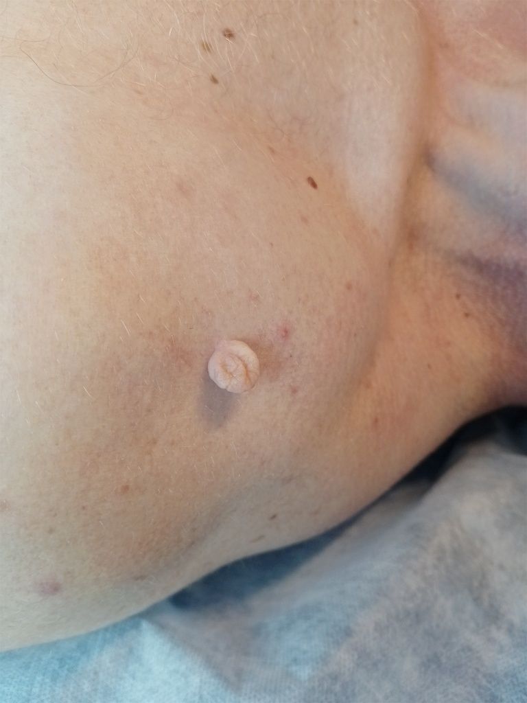 Pielęgnacja Mężczyzni Masaż Depilacja Usuwanie Zmian/tatuażu, Kolczyki