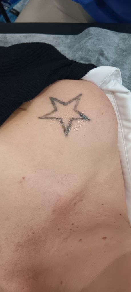 Depilação e remoção de tatuagens a laser