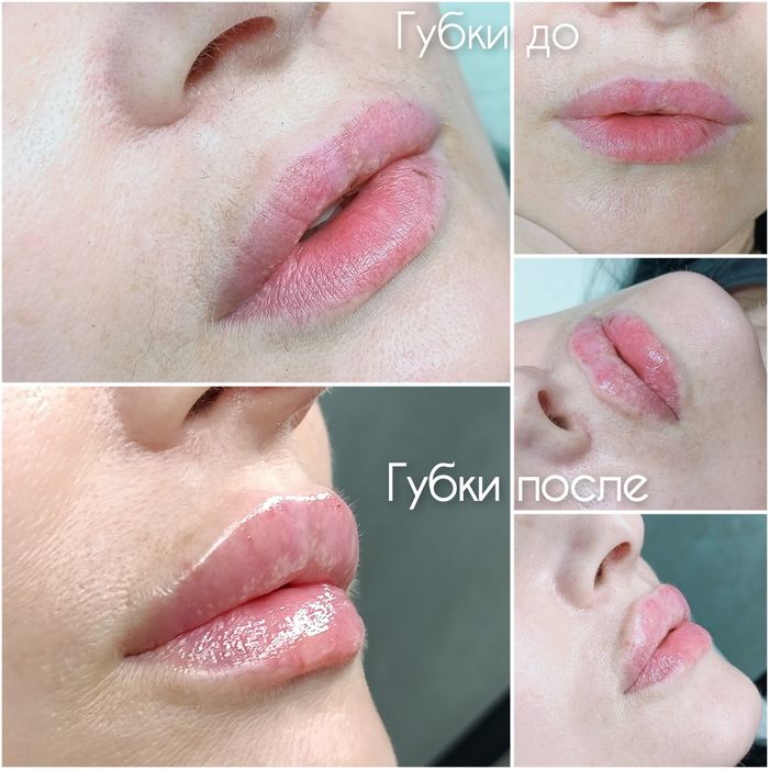 Контурна пластика губ!  2500грн.Потрібні моделі!