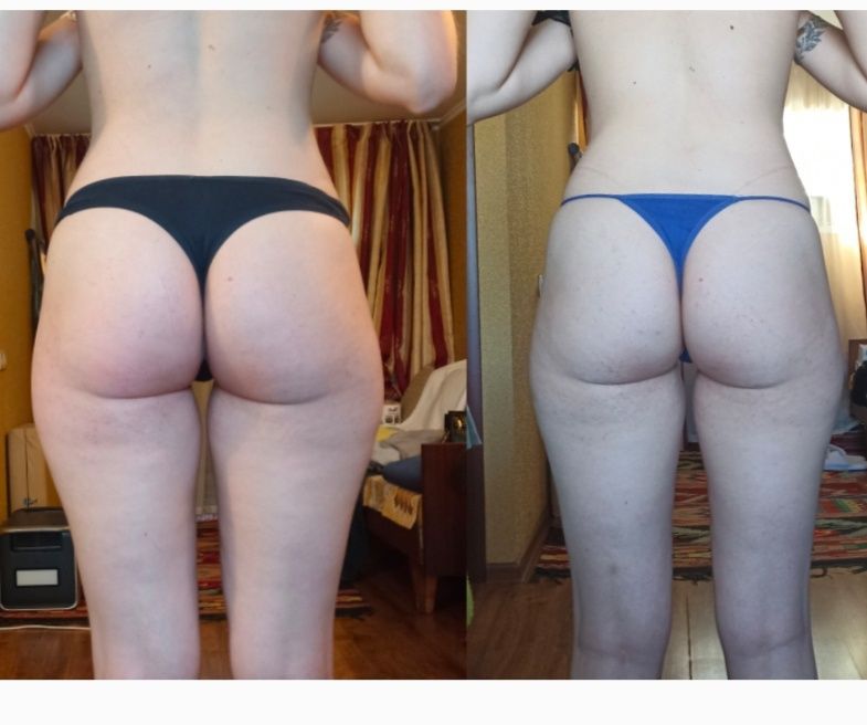 Масаж вакумно роликовий