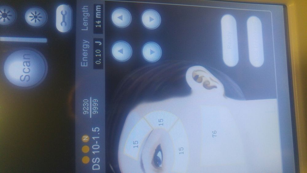 Hifu hifu skalpel bez skalpela likwidacjia salonu