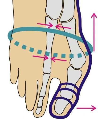 Arthrolux bandaż Skarpety korekcyjne na haluks  S 34-36 kolor czarny