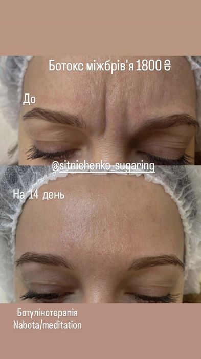Ботулінотерапія,botox