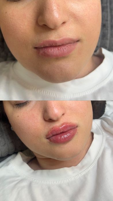 Ботокс.Увеличение губ.Гипергидроз