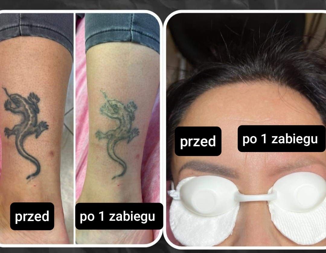 Laser do usuwania tatuażu i makijażu permanentnego Double Plus Pro.
