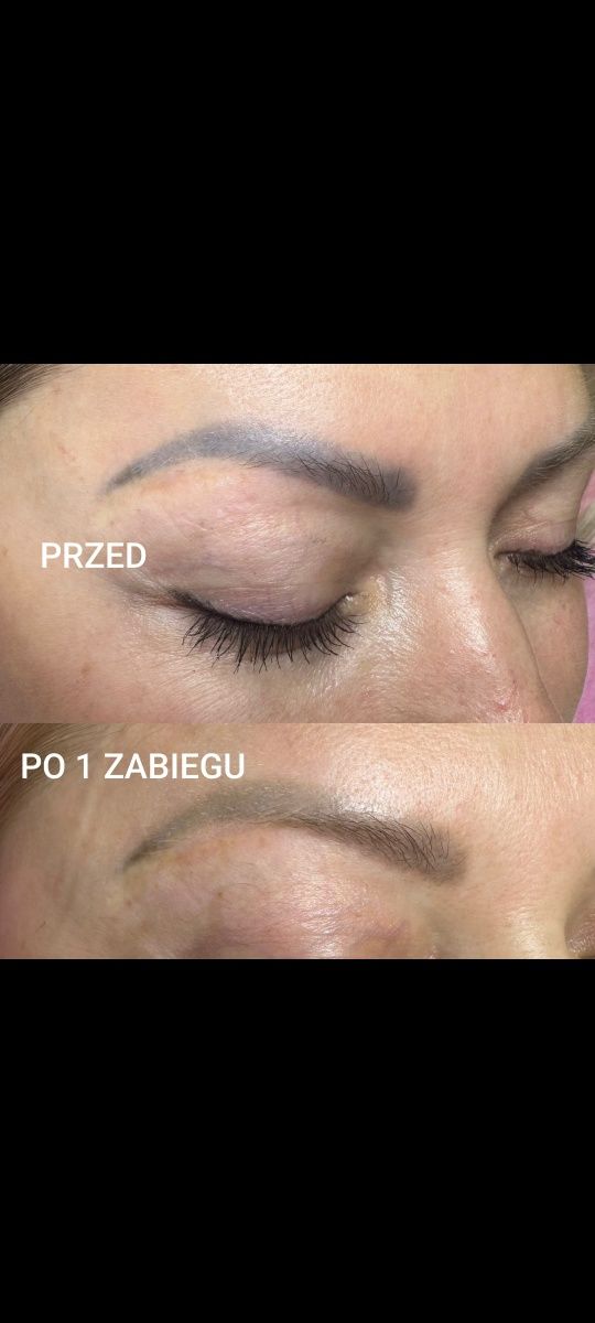 Laser do usuwania tatuażu i makijażu permanentnego Double Plus Pro.