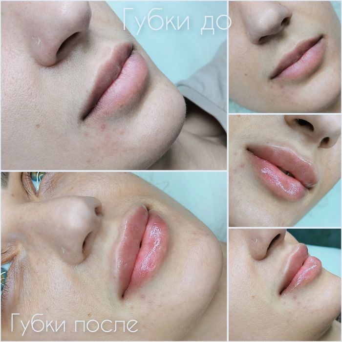 Контурна пластика губ!  2500грн.Потрібні моделі!