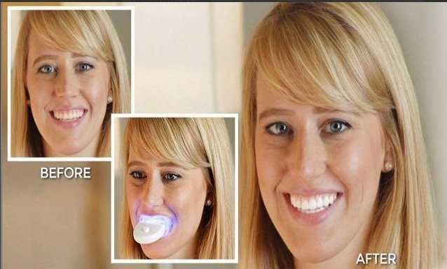 Средство для отбеливания зубов  20 Minute Dental White
