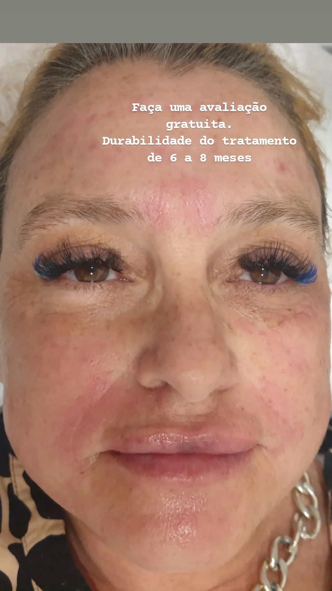 Preenchimento labial e harmonização facial e Lipo enzimática