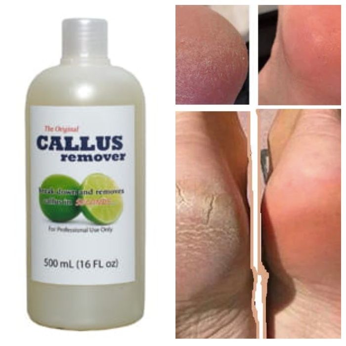 Гель для кислотного педикюра Callus Remover (США)