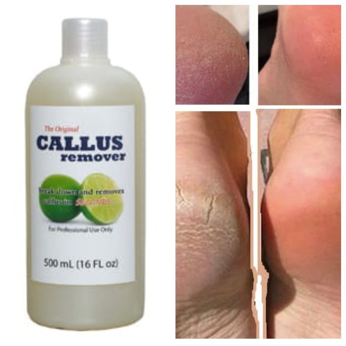 Каллус ремувер Гель для кислотного педикюра Callus Remover (США)