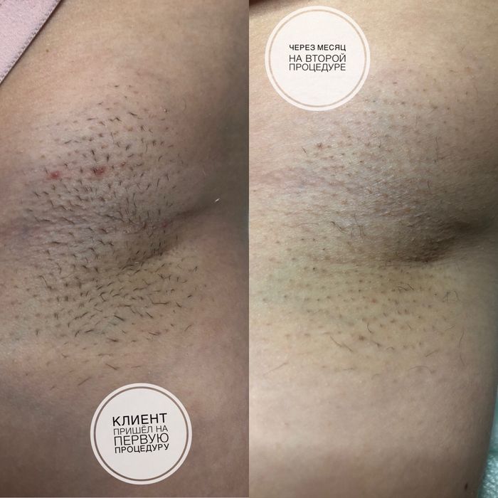 Лазерная эпиляция