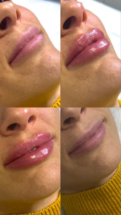 Шукаю моделей на контурну пластику губ,препарати тільки сертифіковані