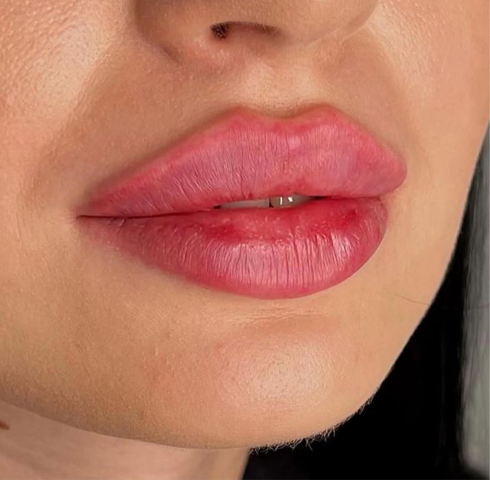 Акція на всю контурну пластику обличчя. Збільшення губ, ботокс, біо