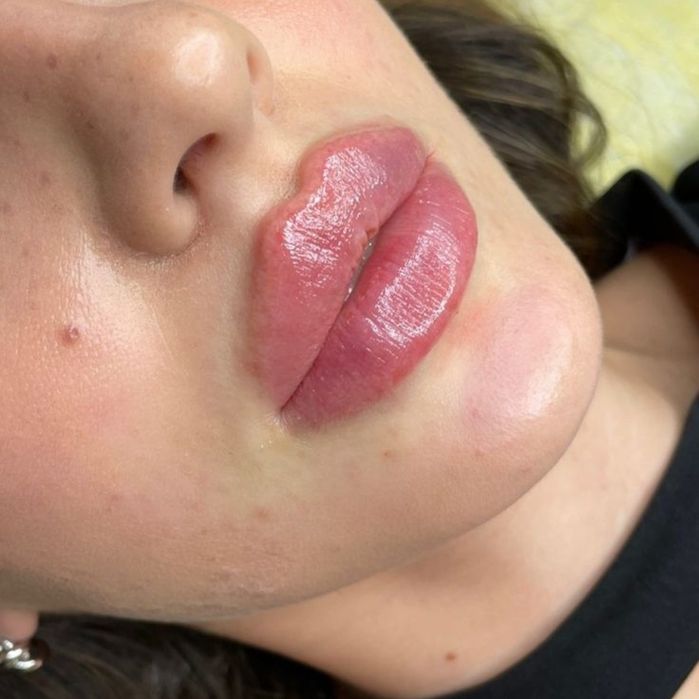 Увеличение губ - 1600. Колличество мест ограничено!