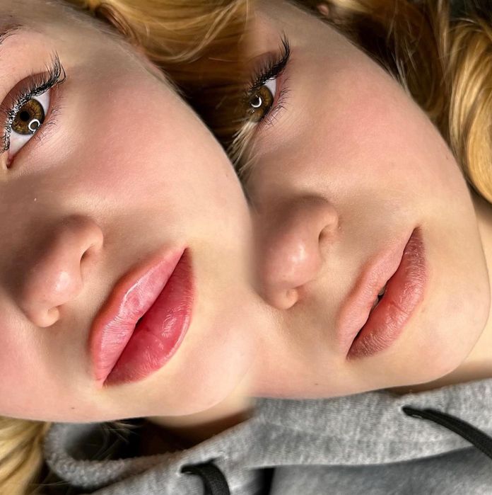 Увеличение губ, 1500 грн, топ техника!